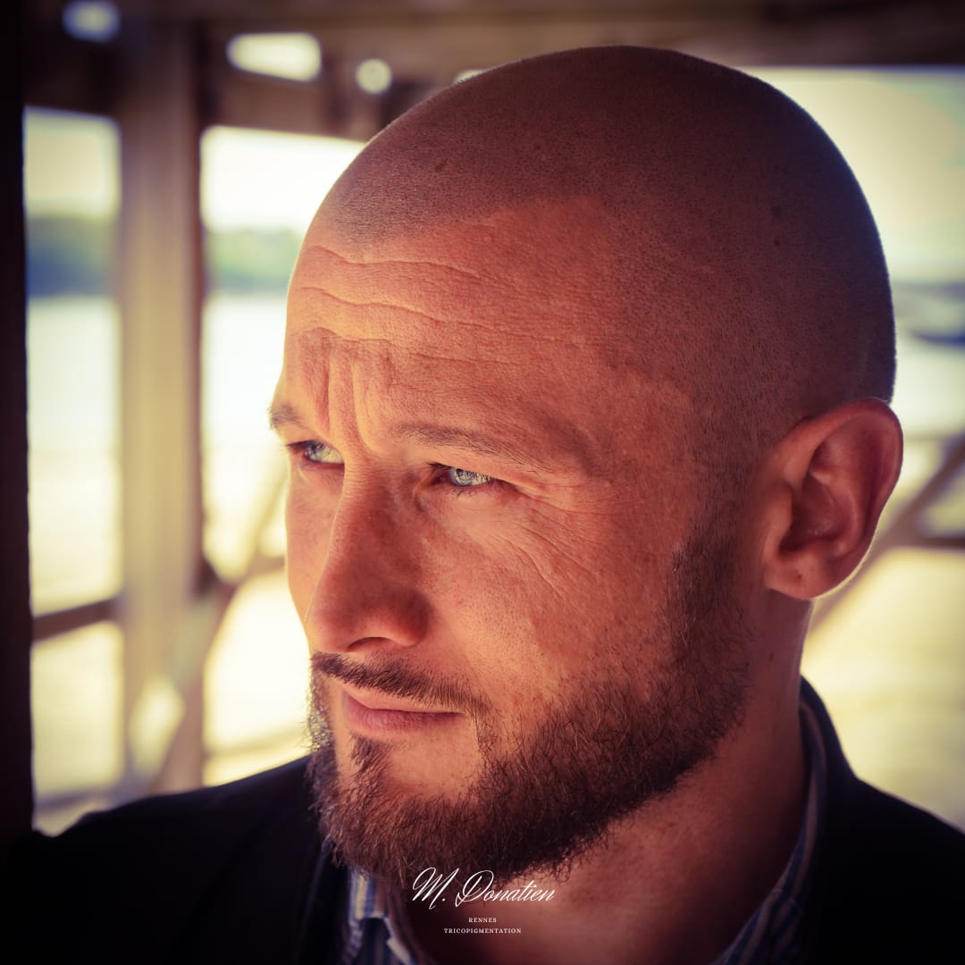 L’effet rasé après cicatrisation : un diaporama photo