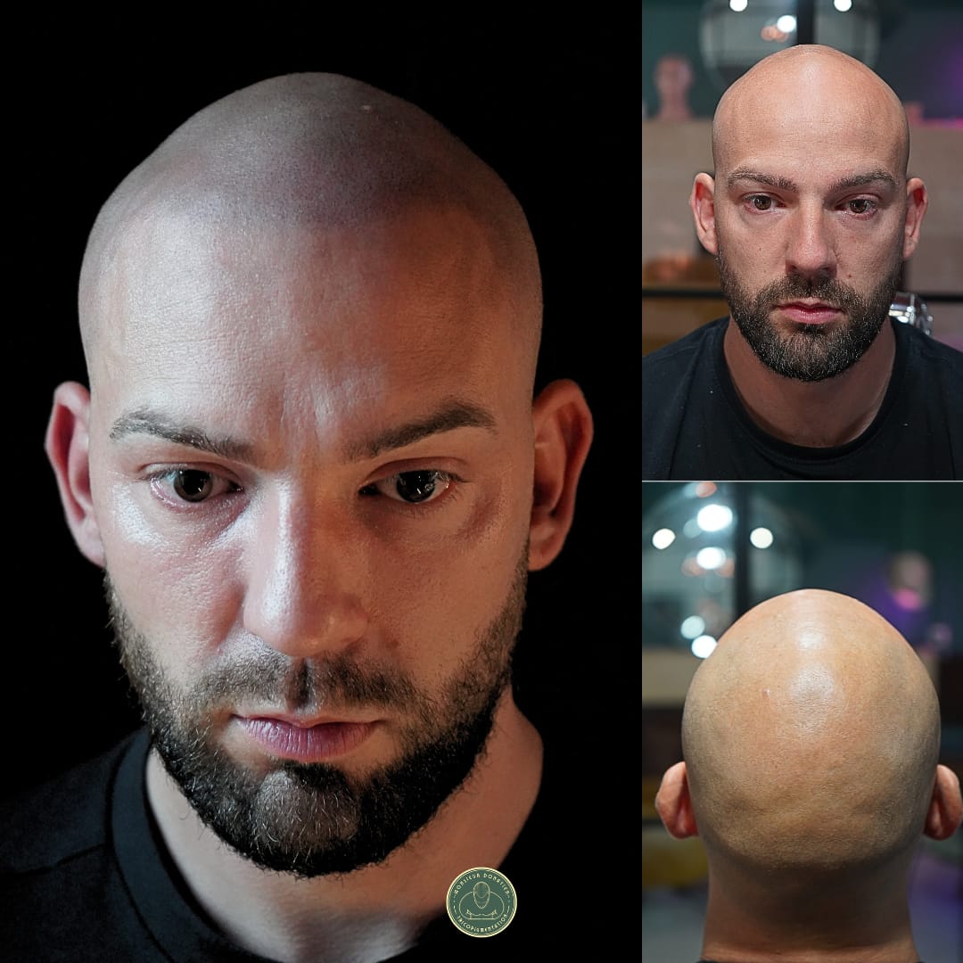 Les sportifs et la calvitie