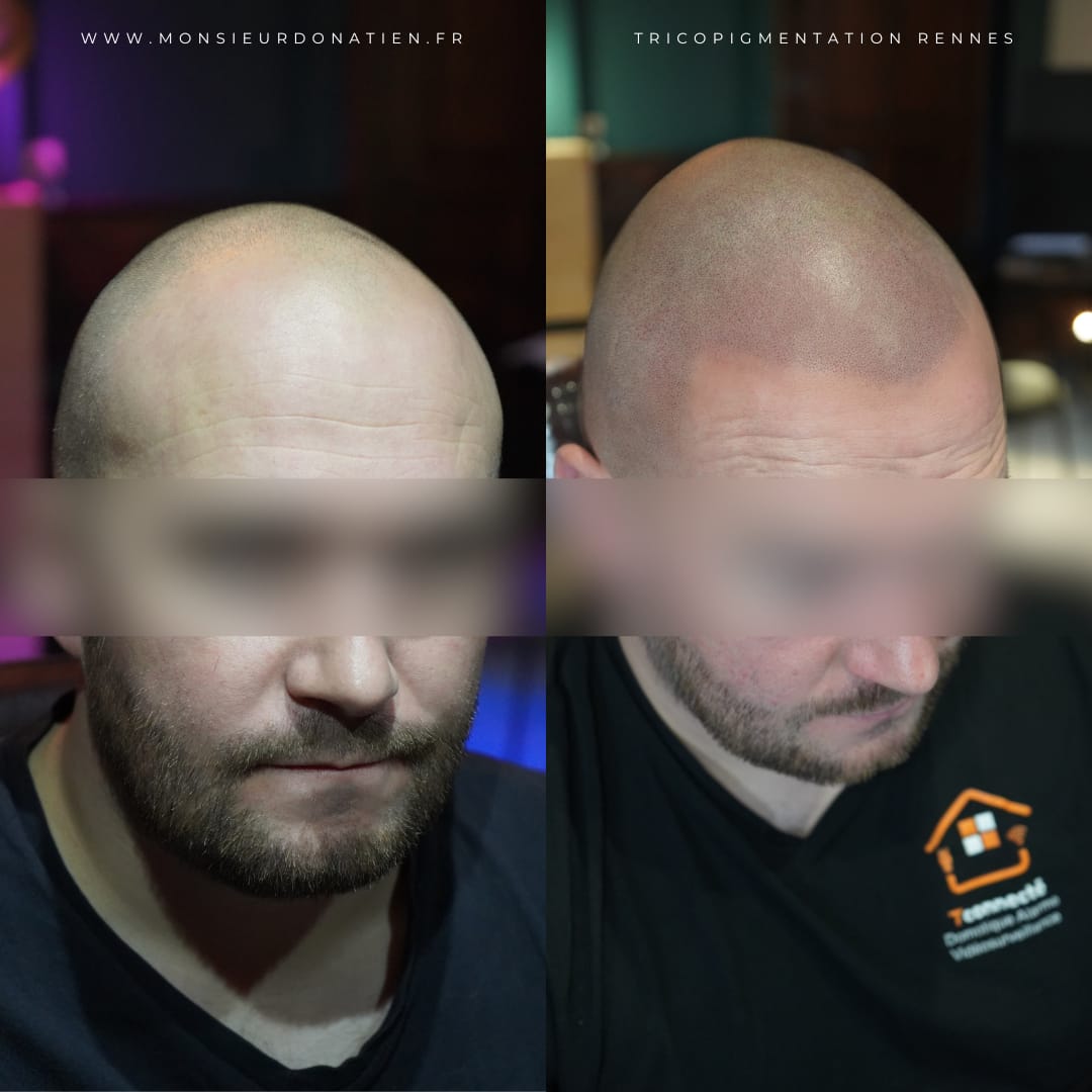 Micropigmentation du cuir chevelu