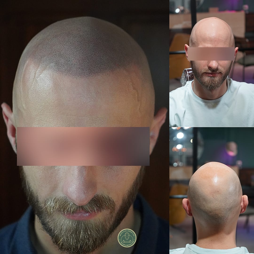 Micropigmentation du cuir chevelu effet Rasé