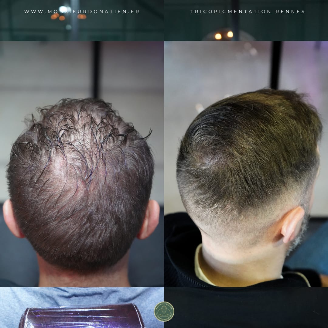 Micropigmentation du cuir chevelu : l&rsquo;effet densité pour un résultat naturel