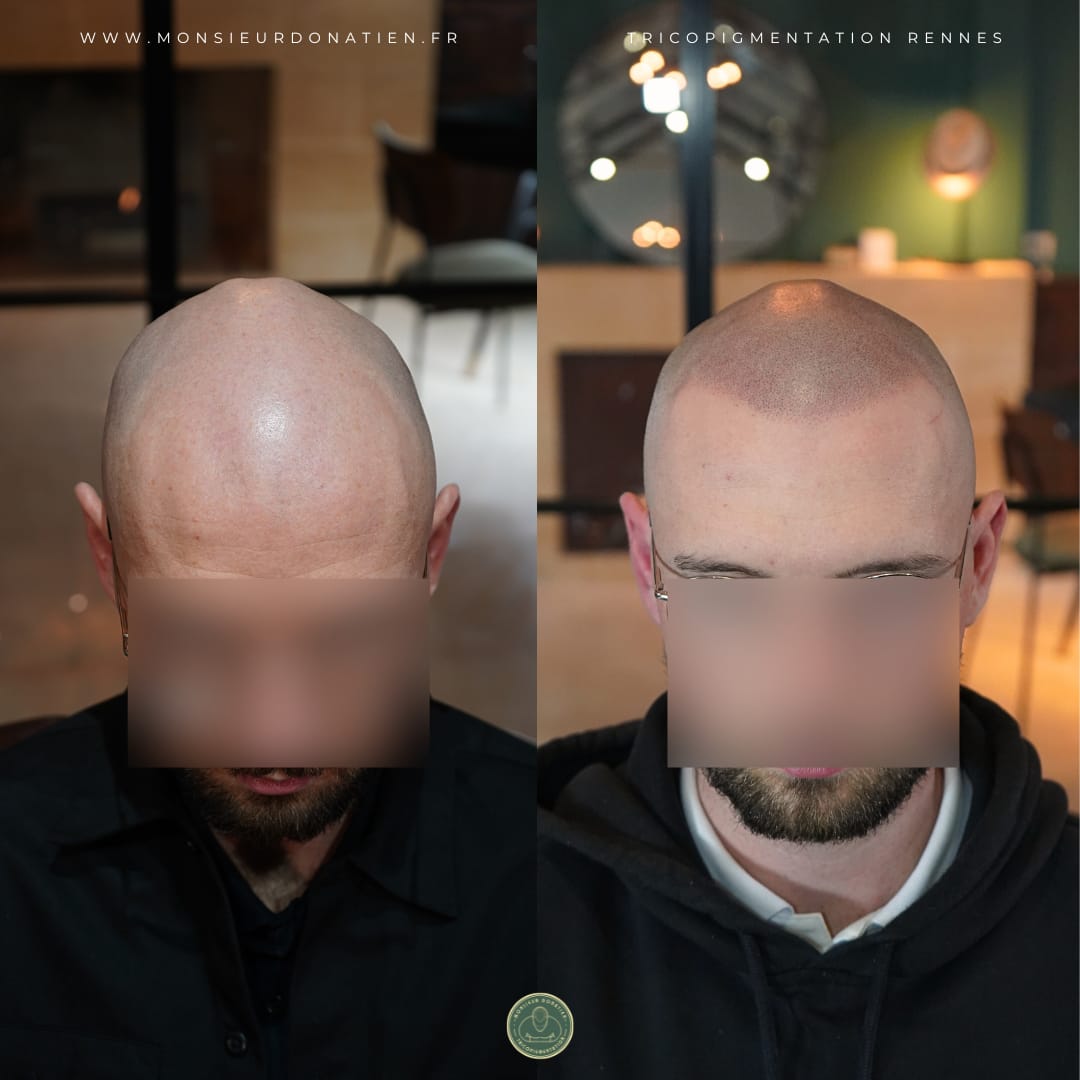 Tricopigmentation effet rasé homme