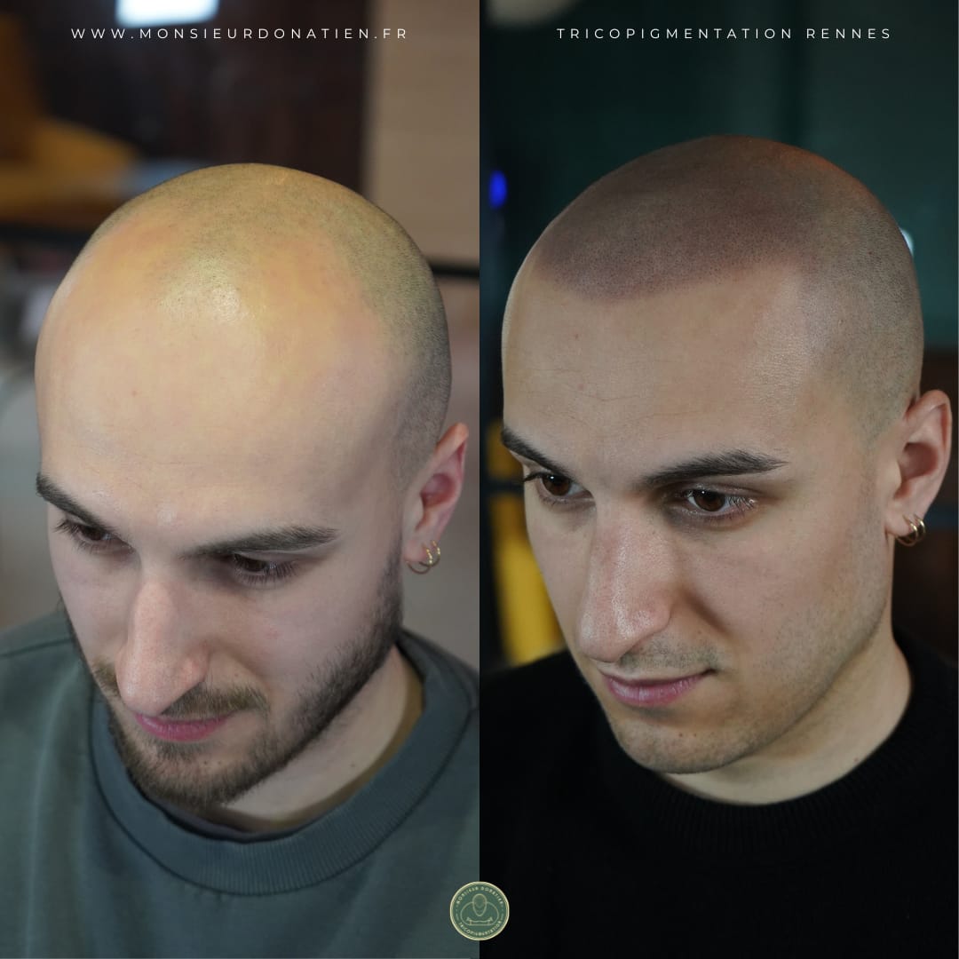 Adieu la casquette : la micropigmentation effet rasé pour une liberté retrouvée