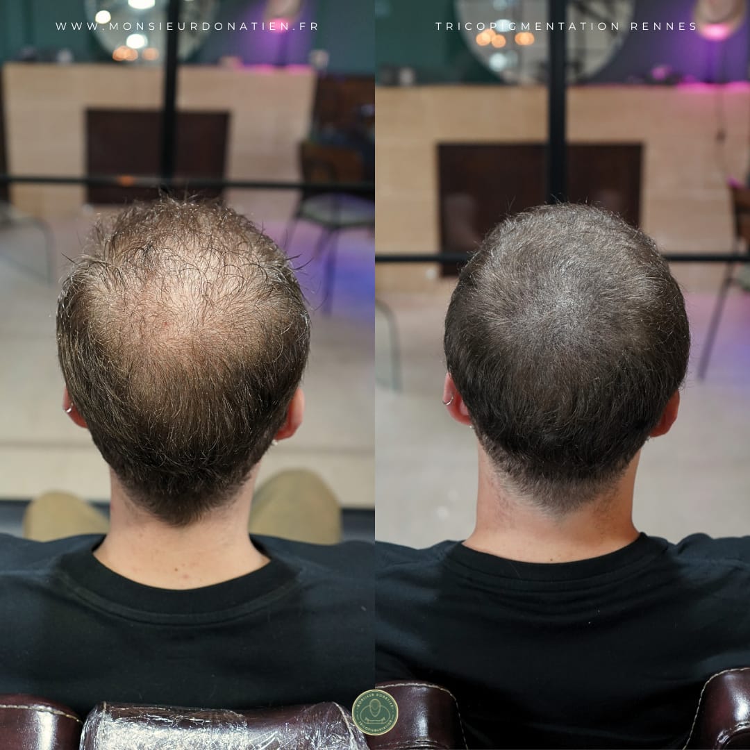 Greffe de cheveux et tricopigmentation : la solution pour une densité parfaite