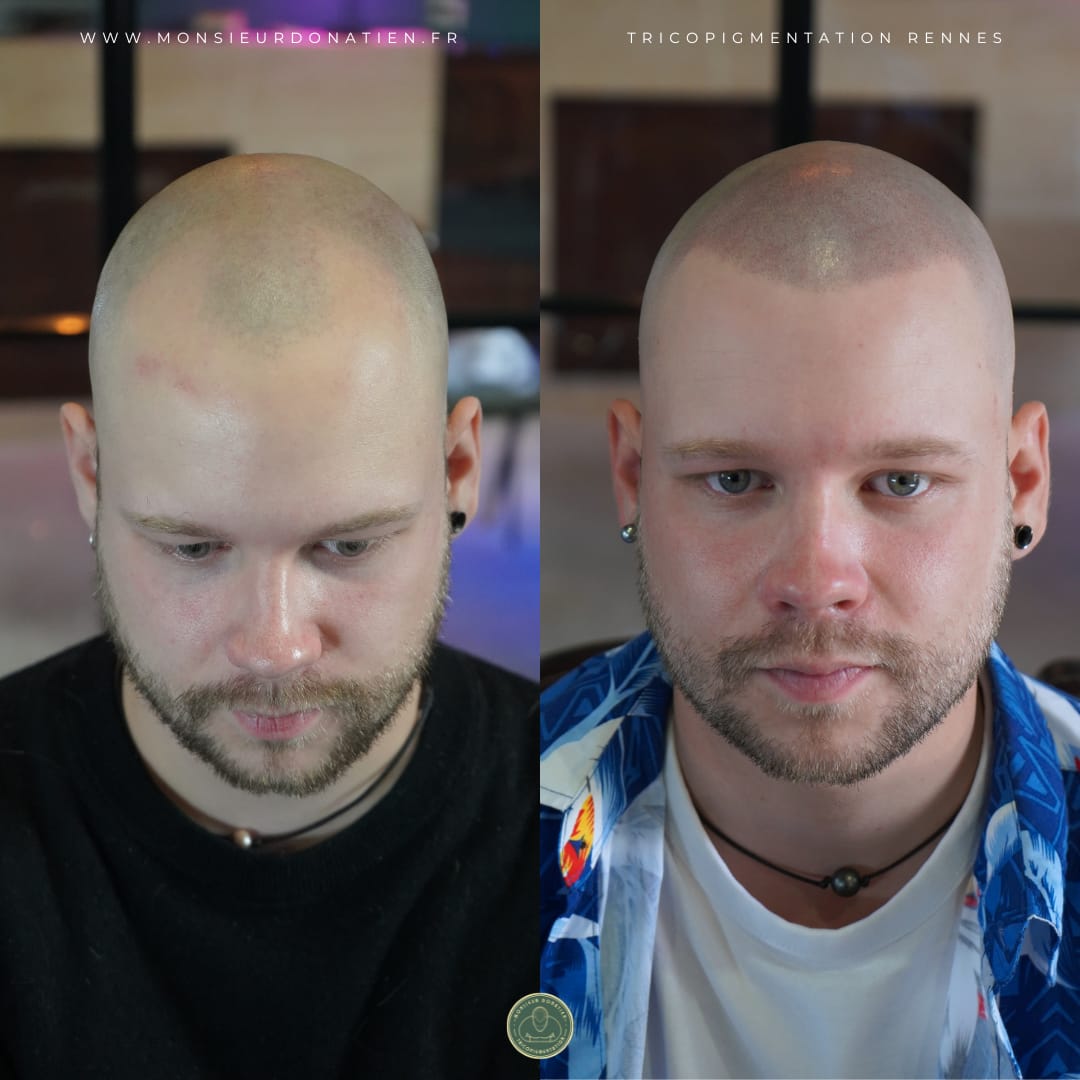 Fin de la prothèse capillaire : la tricopigmentation pour un effet rasé naturel