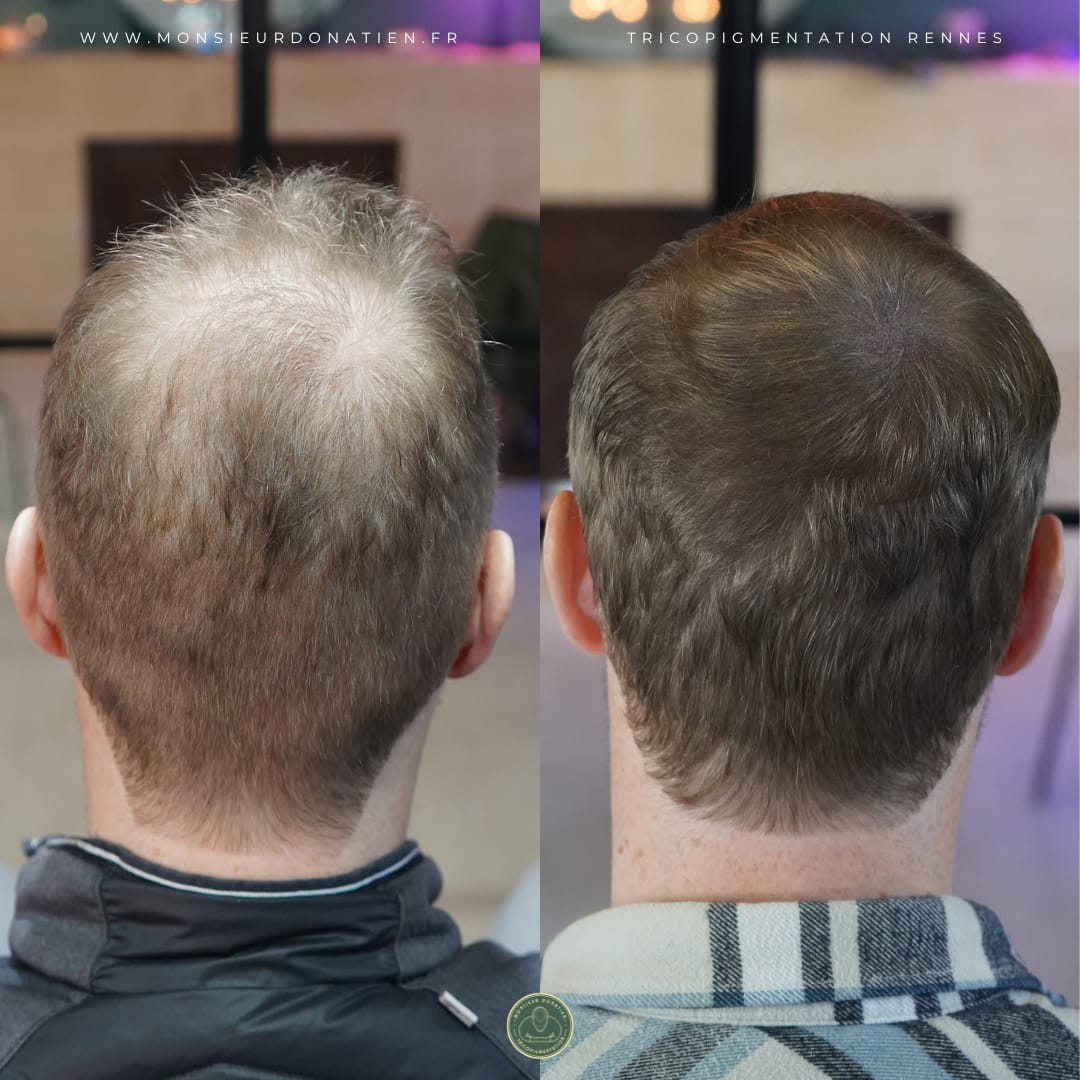 Tricopigmentation homme : la solution densité pour les cheveux châtains clairs