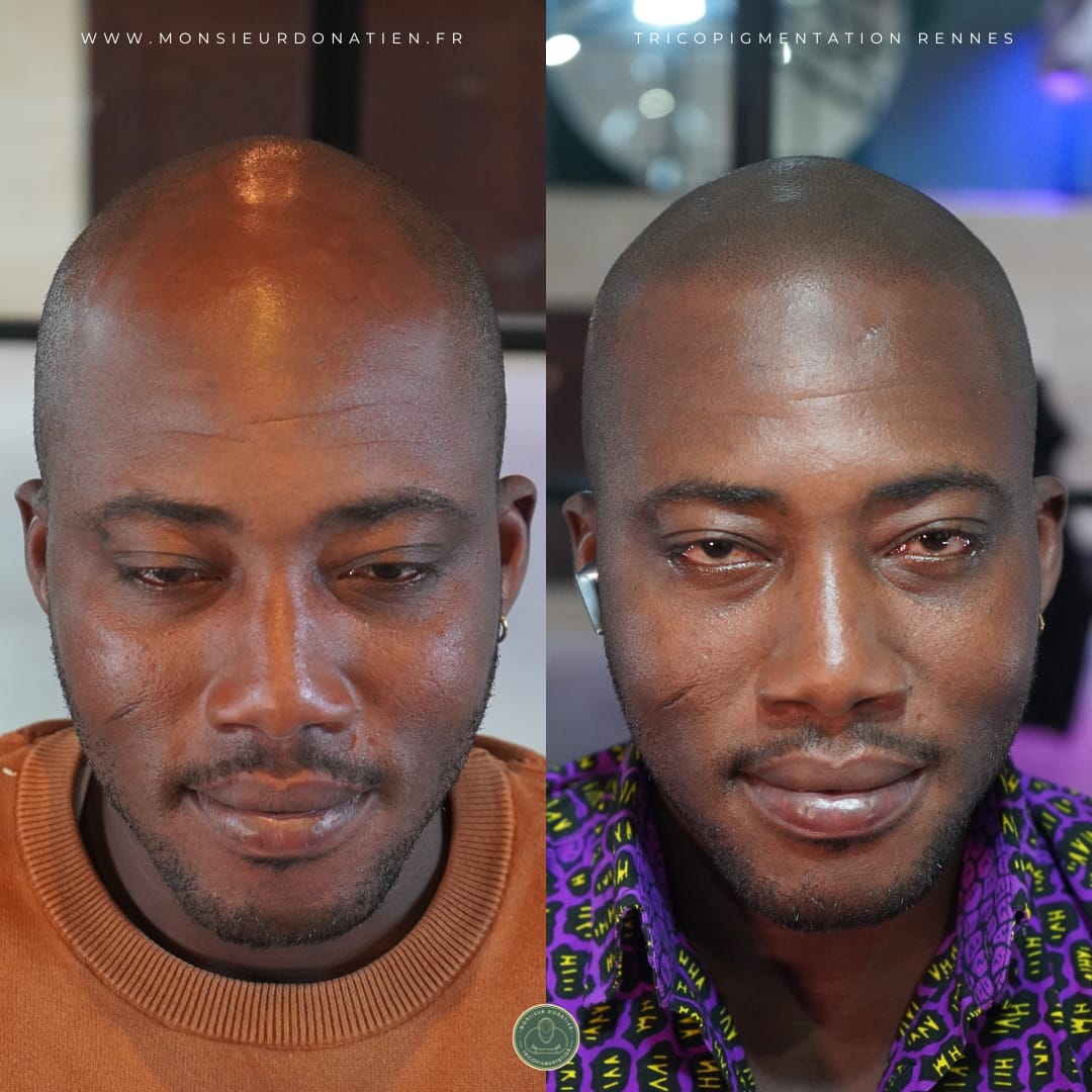 Tricopigmentation et peaux noires : l&rsquo;adaptation pour un résultat naturel