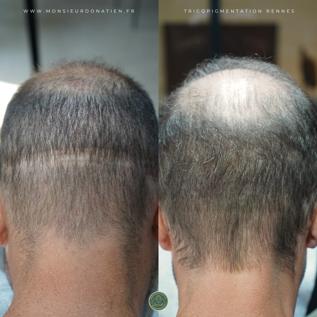 Camouflage cicatrices : La tricopigmentation, une solution efficace