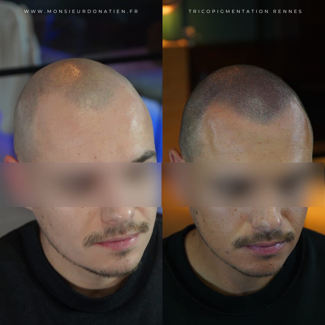 Greffe de cheveux et tricopigmentation : la solution pour une densité parfaite