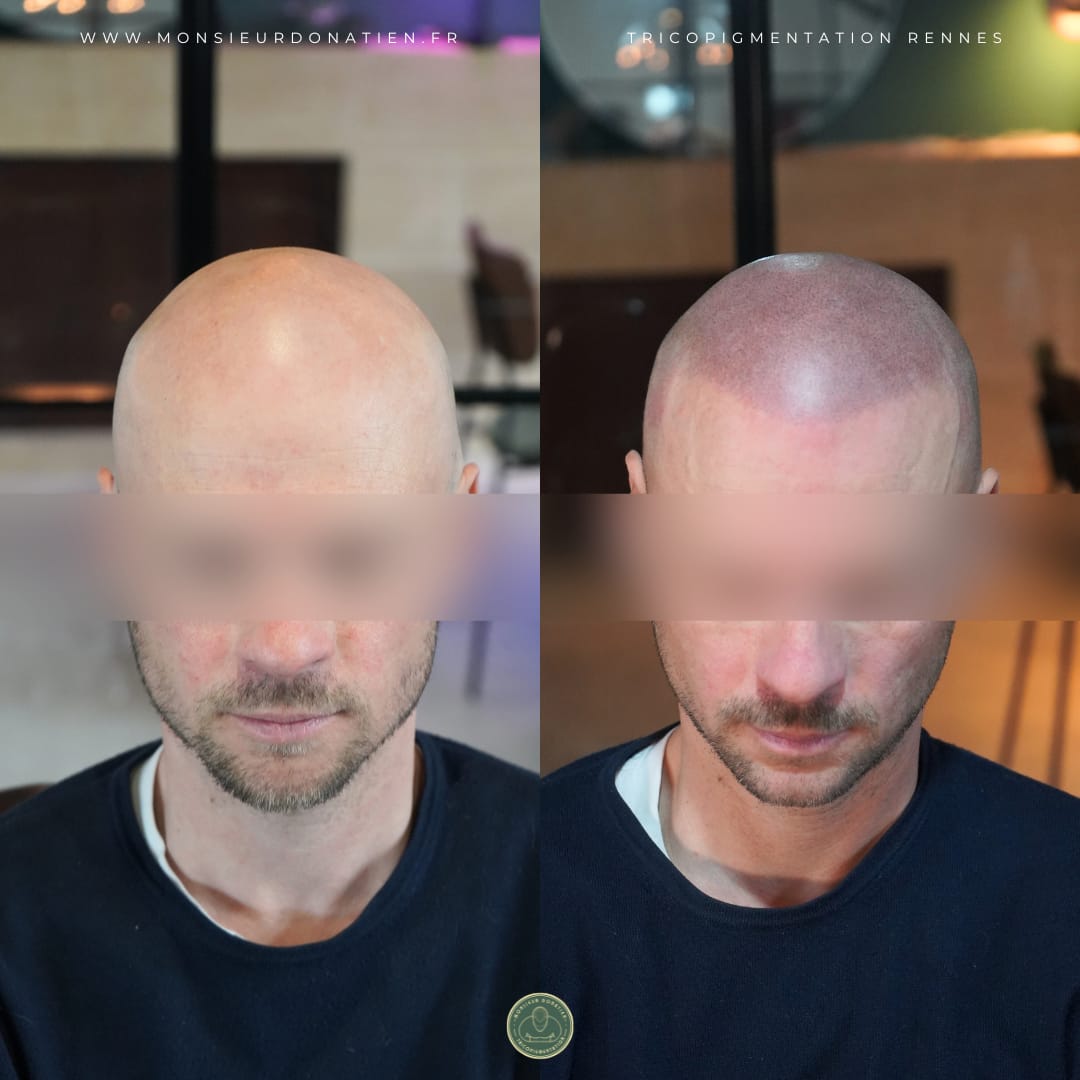 Avant/Après tricopigmentation effet rasé