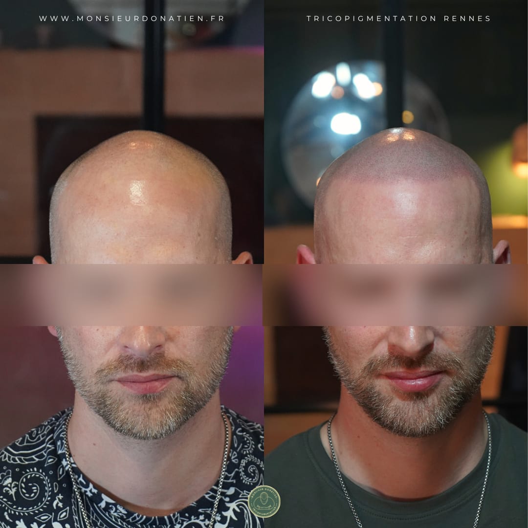 Avant/Après tricopigmentation effet rasé