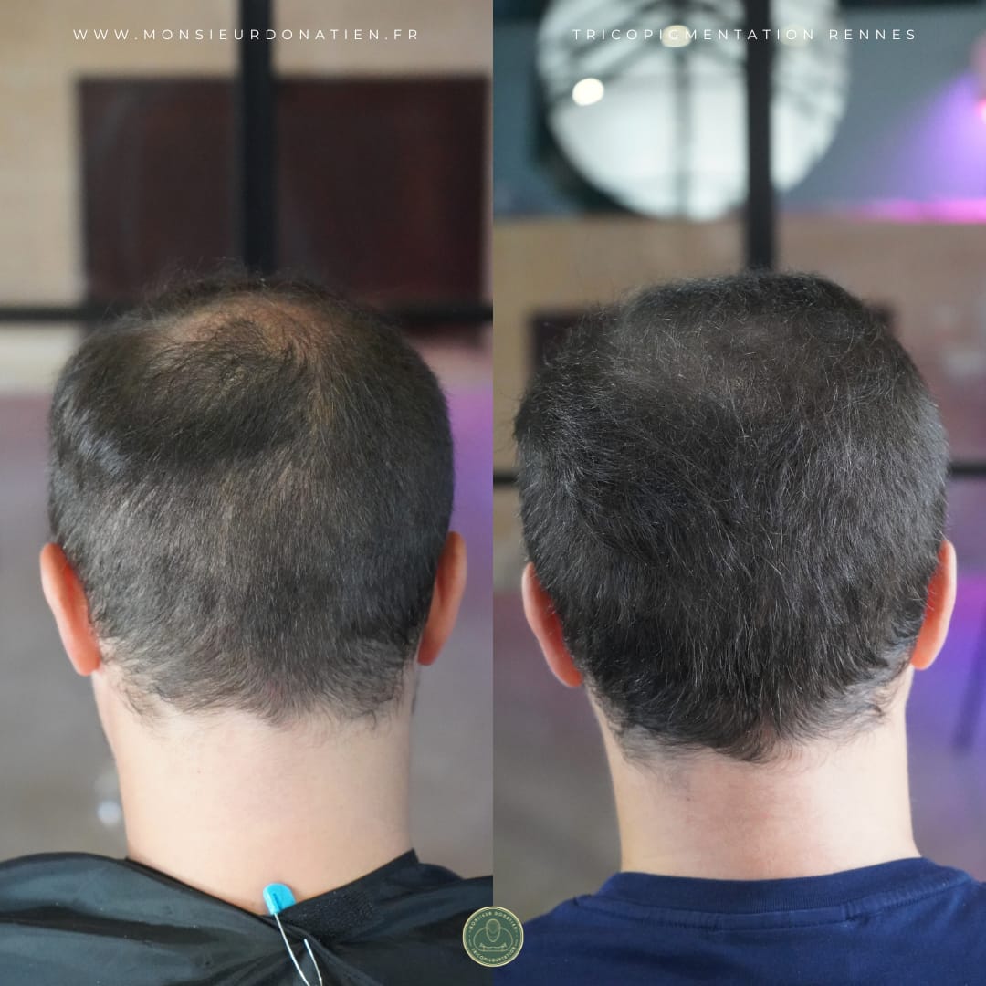 Une solution pour retrouver de la densité après une greffe