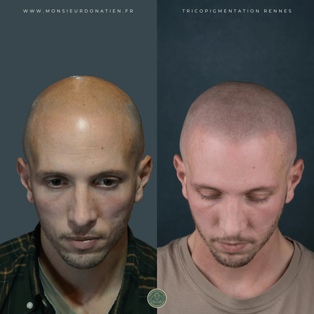 Avant/Après tricopigmentation effet rasé