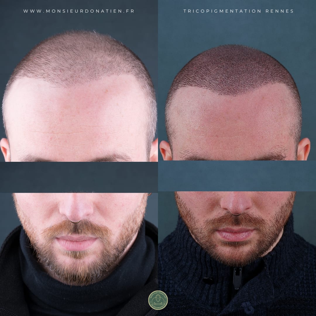 Micropigmentation effet hybride : entre effet rasé et effet densité