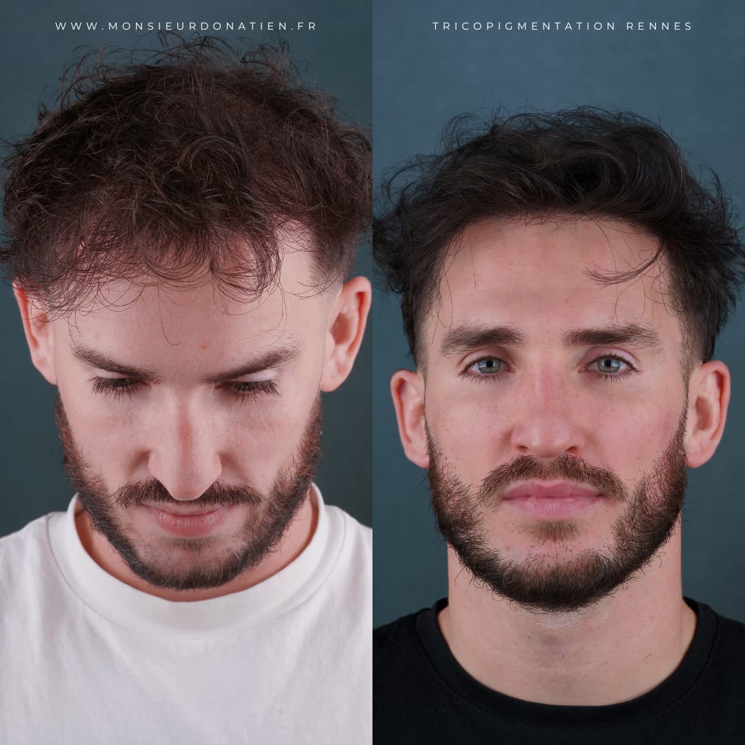 Micropigmentation effet densité : redonner du volume à la chevelure