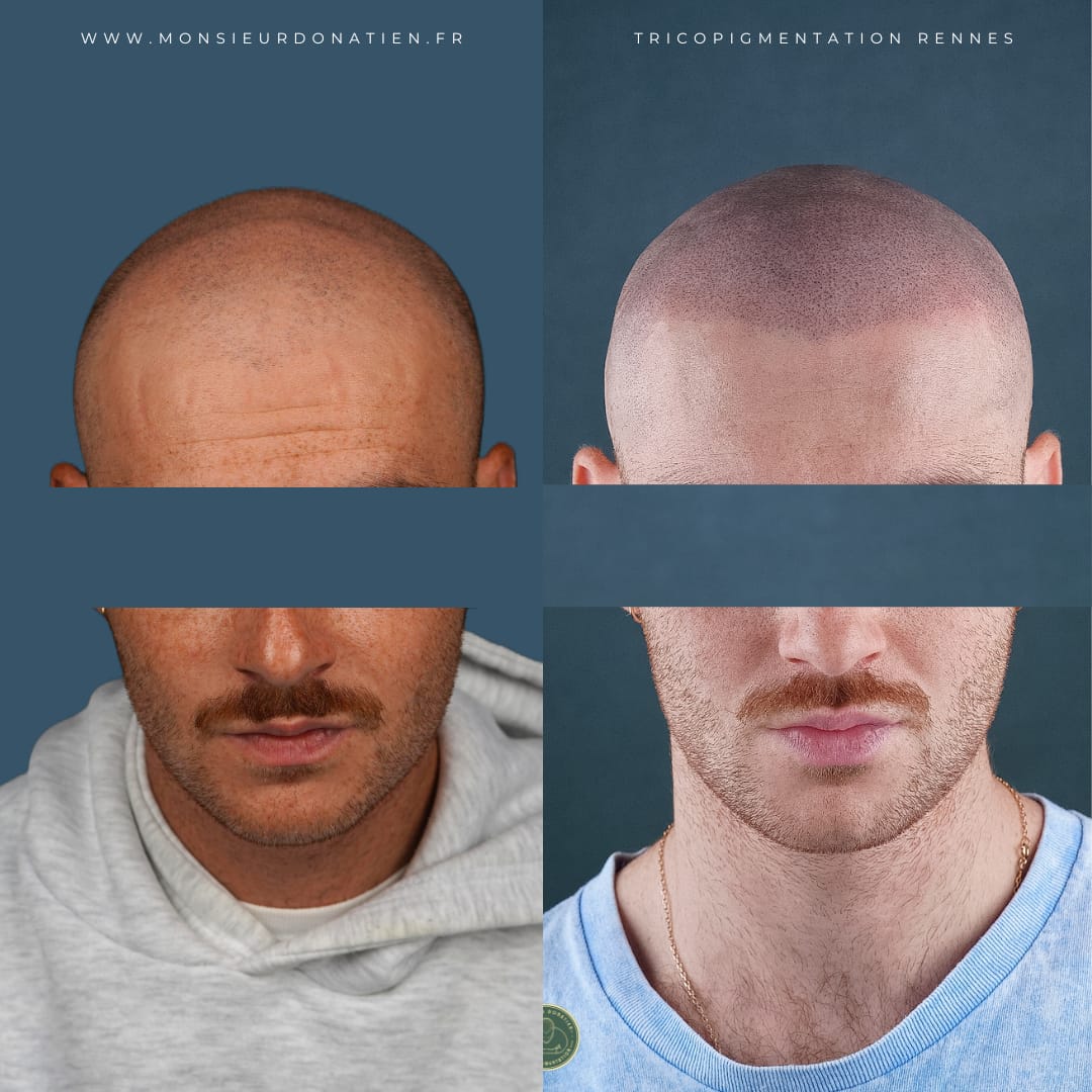 Avant/Après tricopigmentation effet rasé