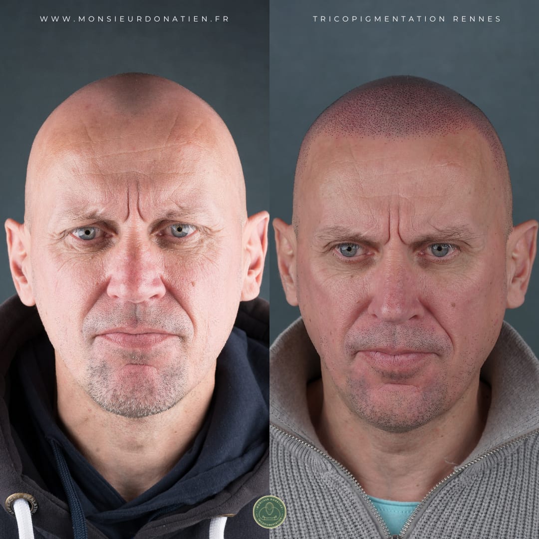 Avant/Après tricopigmentation effet rasé