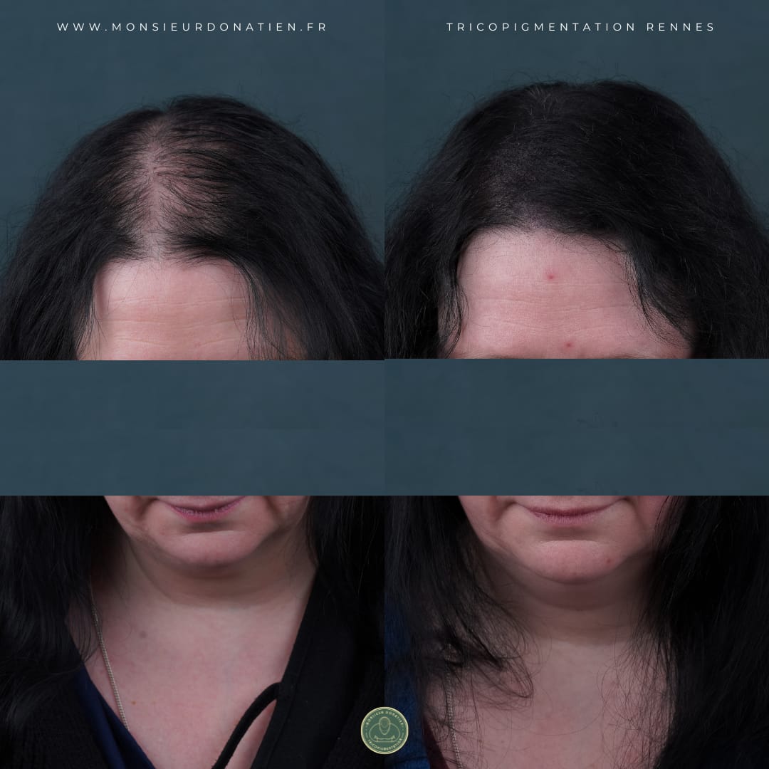 Tricopigmentation effet densité femme