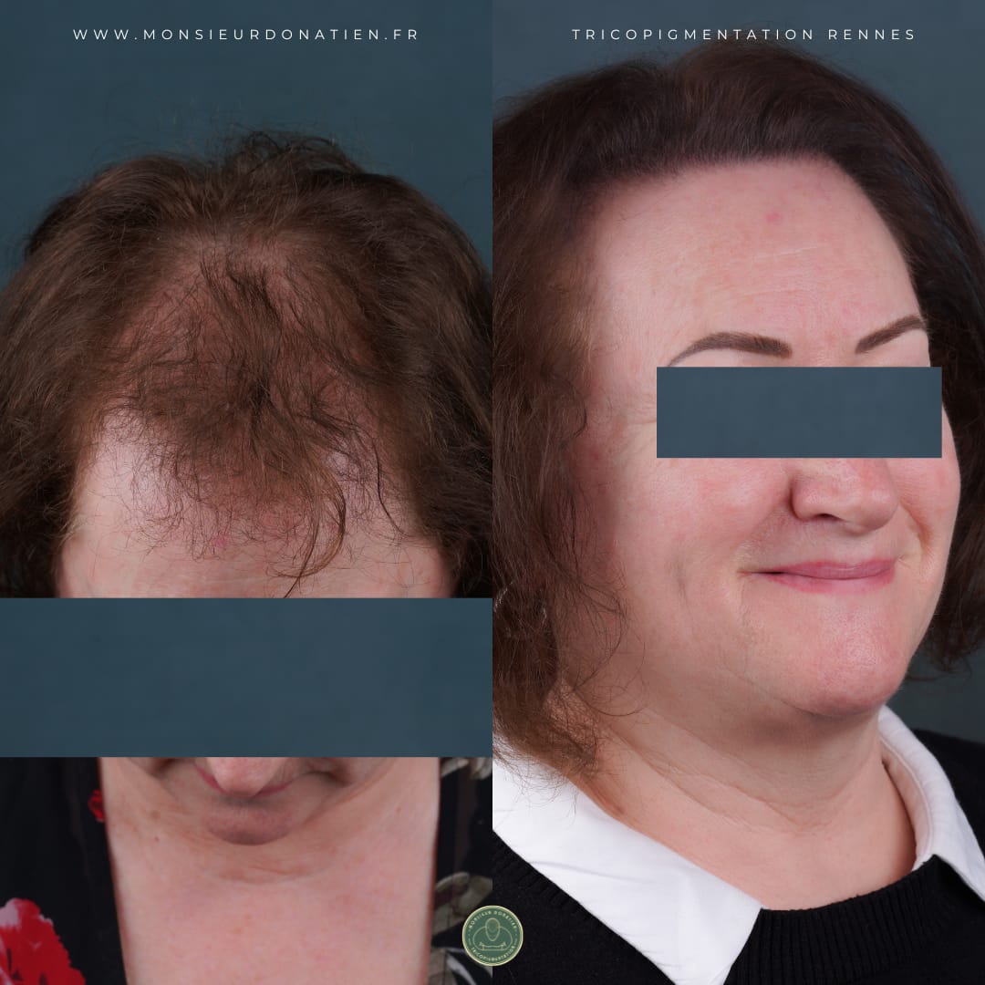 Retrouver confiance grâce à la tricopigmentation