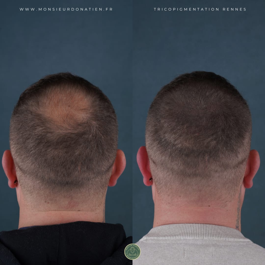 Comment densifier un vertex dégarni avec la tricopigmentation ?