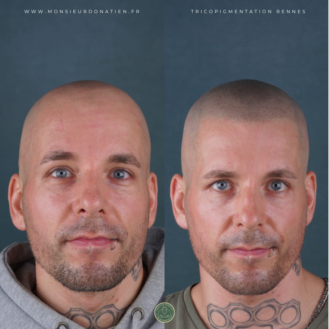 Avant/Après tricopigmentation effet rasé