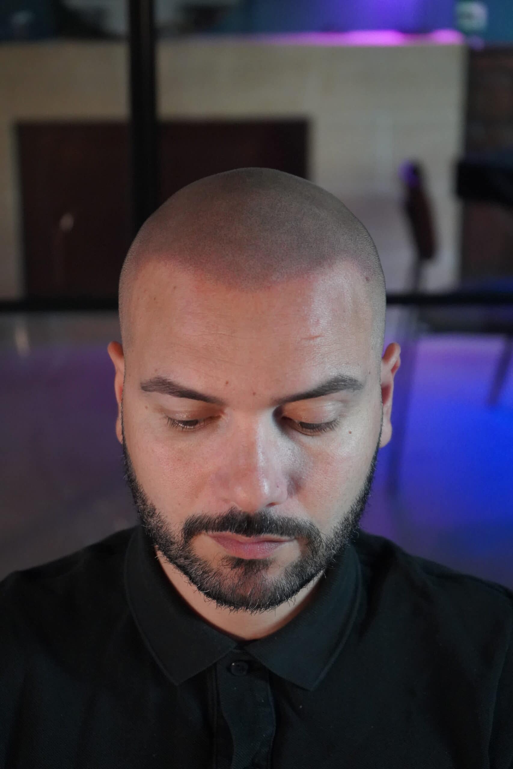 Retouche de micropigmentation après 2 ans : le cas de Kévin