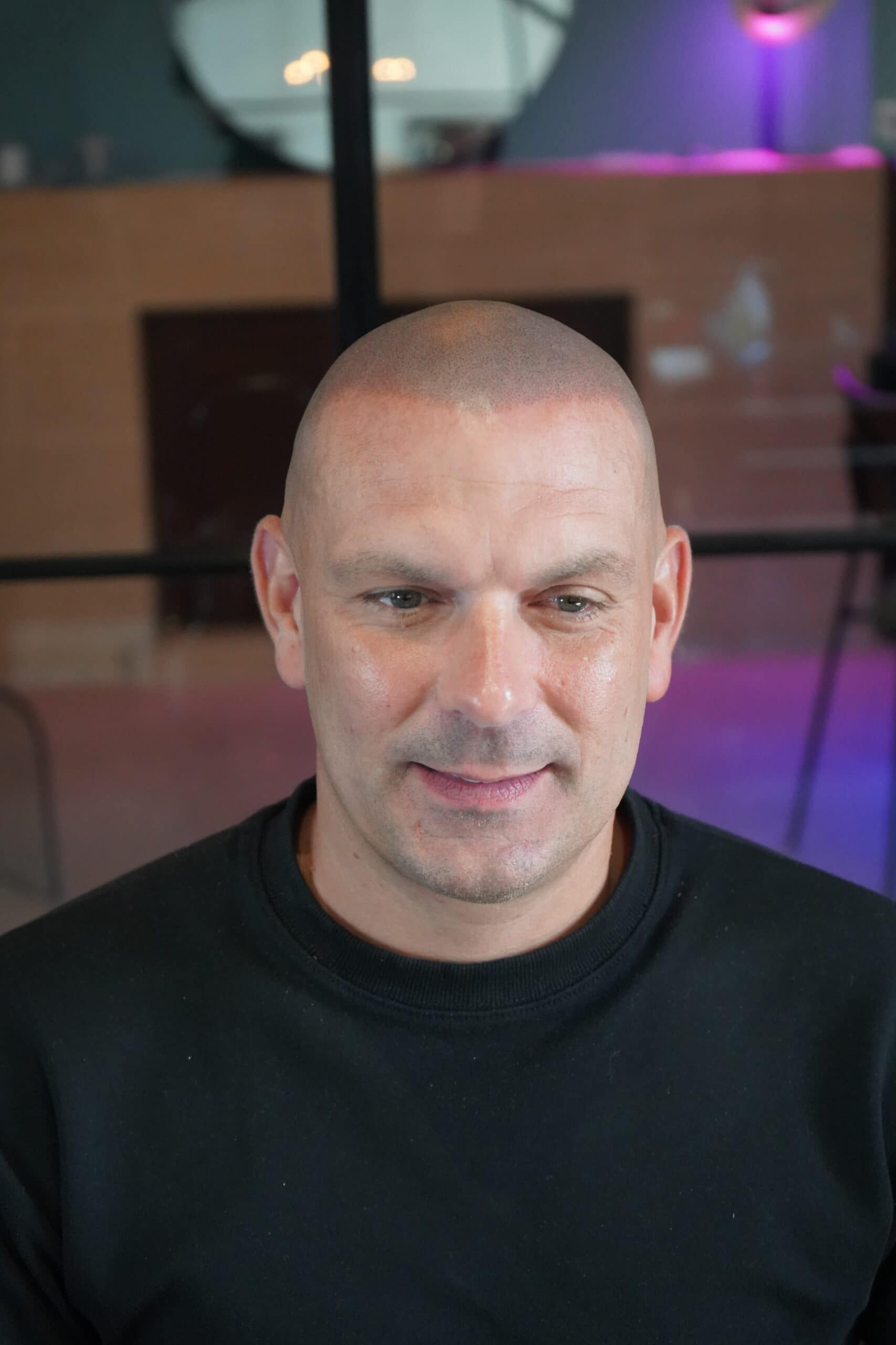 Retouche d’une micropigmentation effet rasé