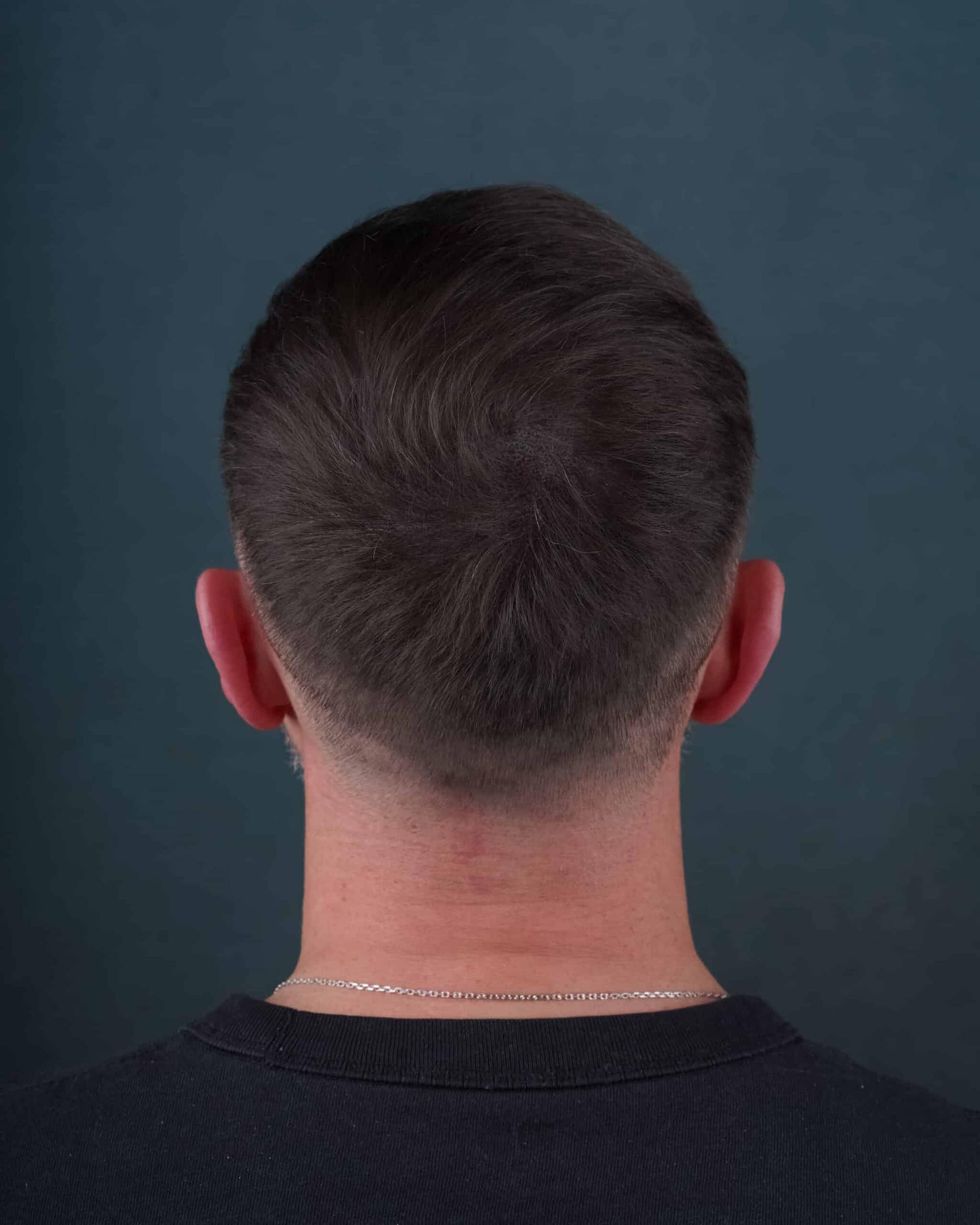 Comment densifier un vertex dégarni avec la tricopigmentation ?