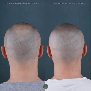 Comparatif profil micropigmentation