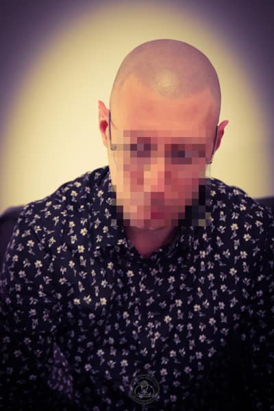 Micropigmentation capillaire Effet rasé